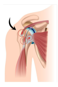 Diagram of a shoulder with rotator cuff problems