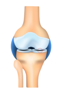 Diagram of stage 1 knee osteoarthritis