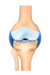 Diagram of stage 2 knee osteoarthritis