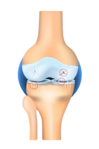 Diagram of stage 3 knee osteoarthritis