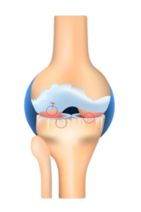 Diagram of stage 4 knee osteoarthritis
