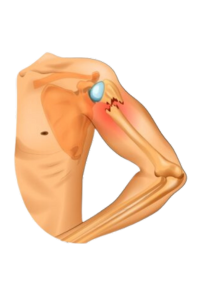Diagram of fracture of the humerus body