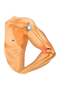 Diagram of fracture of the distal part of the humerus